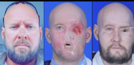 Will eye and face transplants become more common? First recipient is making a strong recovery